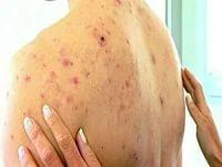 прыщи на спине и груди