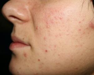 подкожные прыщи на лице фото