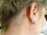 псориаз волосистой части головы