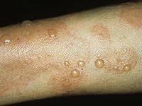 пузырчатка лечение