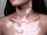 пятна витилиго