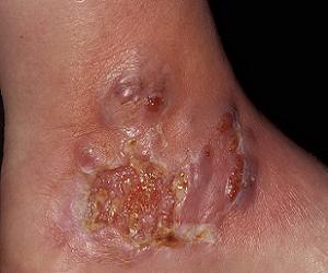 гангренозная пиодермия фото