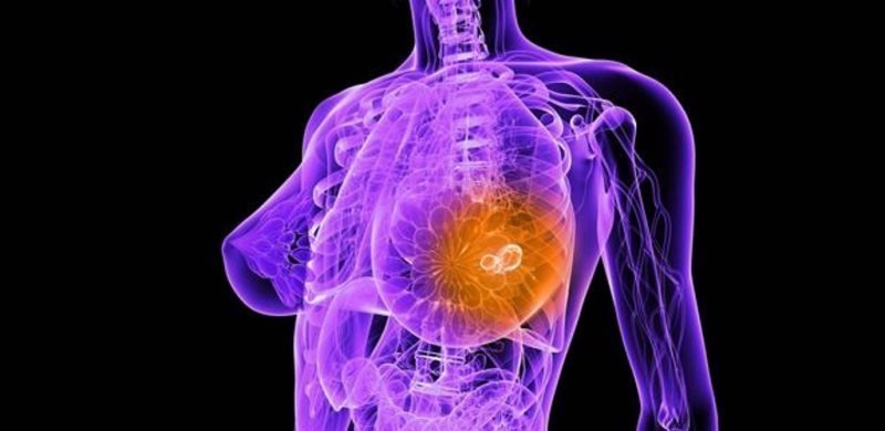 Рак груди 3 стадии