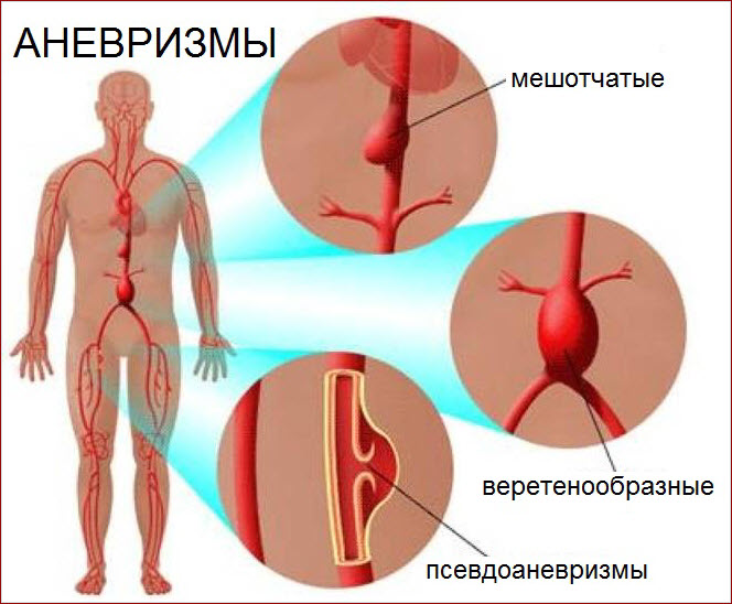 Аневризмы сосудов