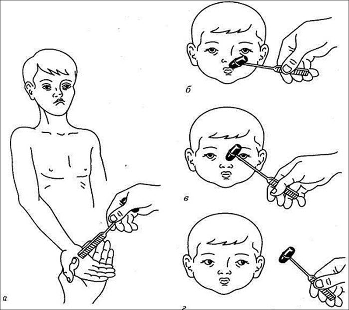 Ладонно подбородочный рефлекс