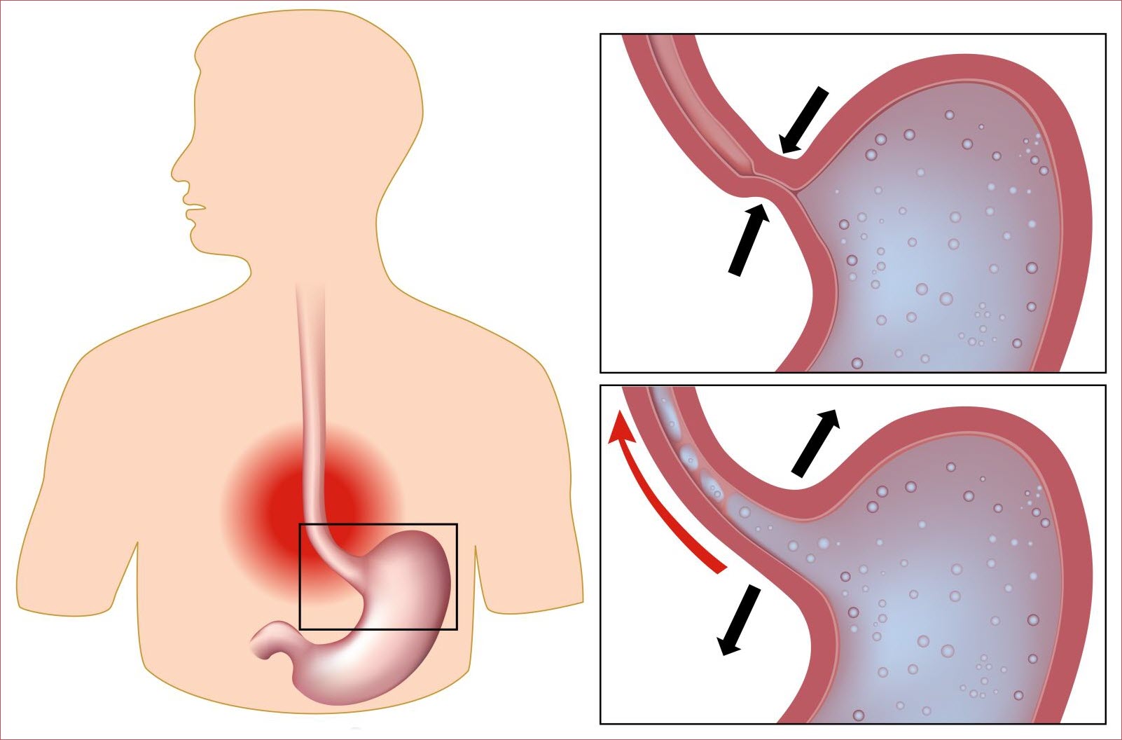 Рефлюкс-эзофагит