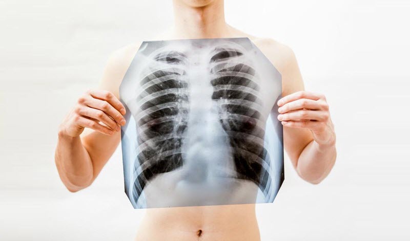 Рентгенография грудной клетки