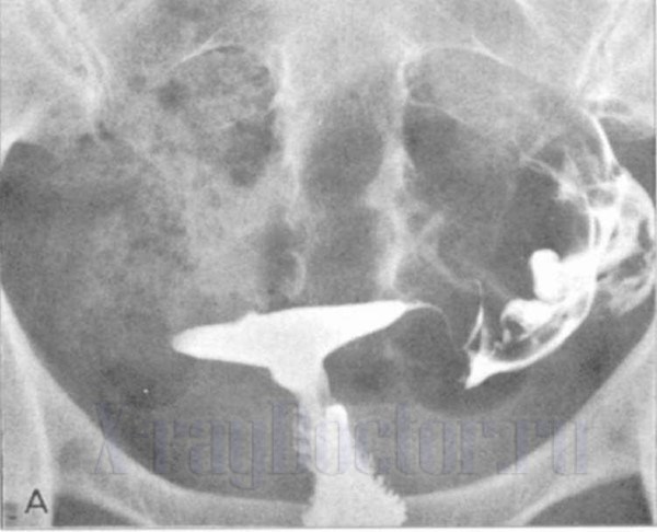 Рентген мочевого пузыря с контрастом