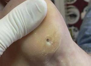 стержневая мозоль фото