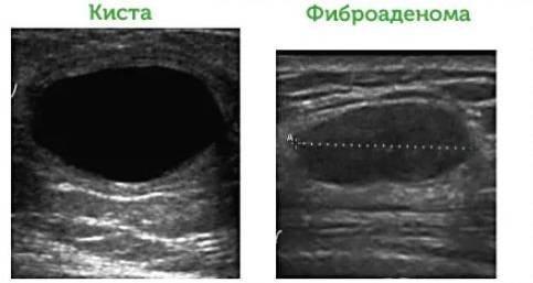 Отличия кисты и фиброаденомы Отличия кисты и фиброаденомы
