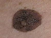 себорейная кератома лечение