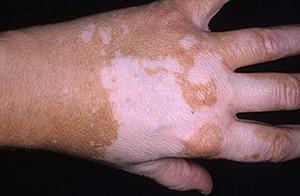 витилиго начальная стадия фото