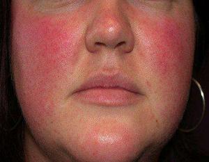 розацеа симптомы фото