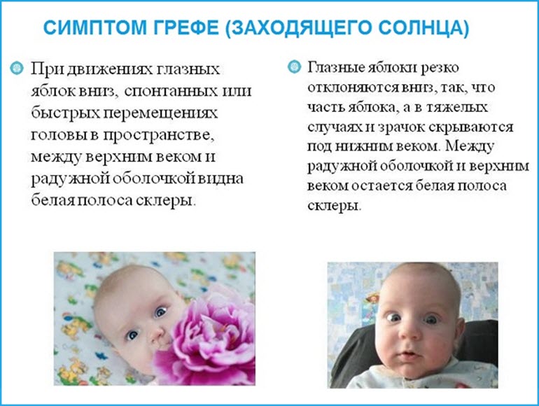 Симптом Грефе