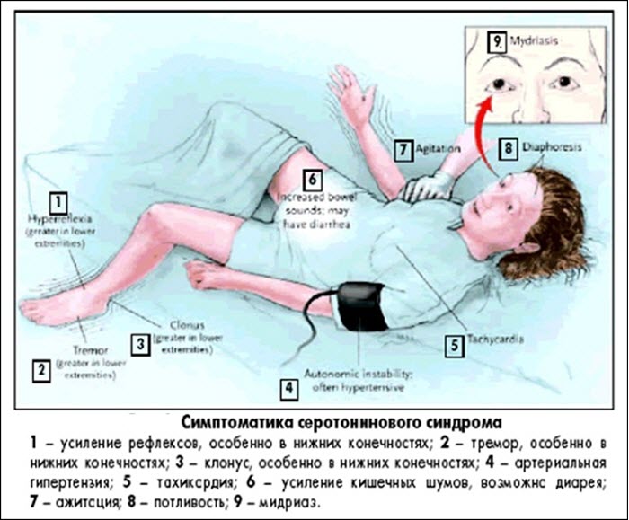 Симптомы серотонинового синдрома