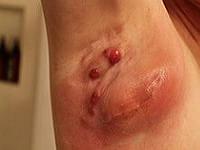 симптомы гидраденита под мышкой