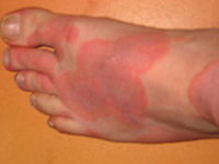 симптомы и лечение крапивницы у взрослых