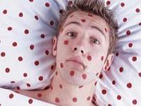 симптомы и лечение краснухи у взрослых