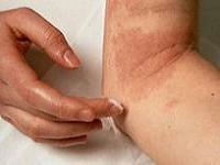 симптомы и лечение нейродермита