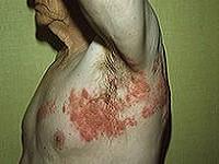 симптомы и лечение опоясывающего герпеса