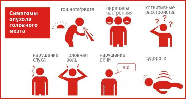 Симптомы мозговой опухоли