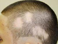 симптомы стригущего лишая у человека