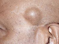 симптомы жировика на теле