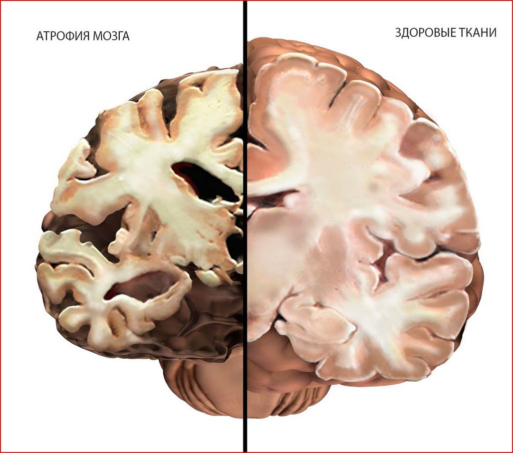 Атрофия мозга