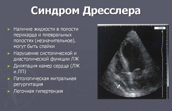 Синдром Дресслера