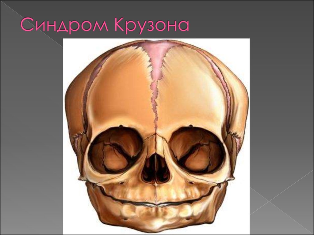 Череп при синдроме Крузона