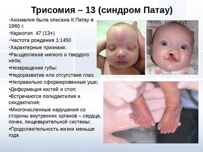 Признаки синдрома Патау