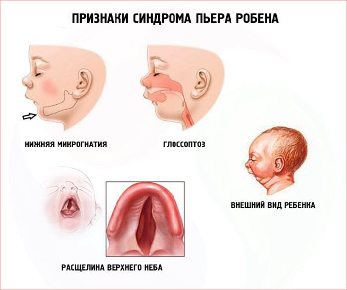 Признаки синдрома Пьера Робена