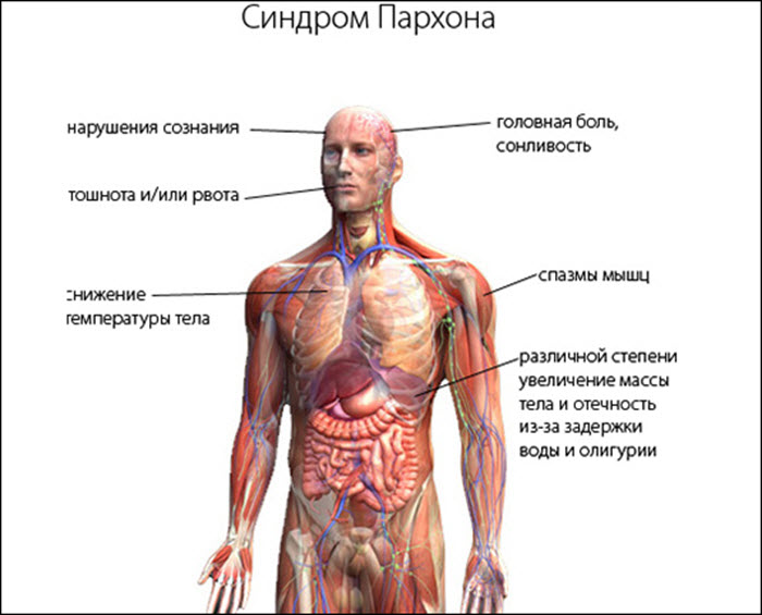 Симптомы синдрома Пархона