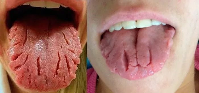 Складчатость языка