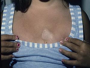 очаговая склеродермия фото