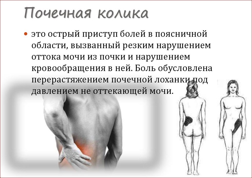 Почечная колика