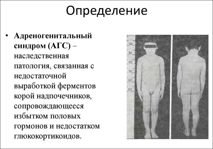 Определение адреногенитального синдрома