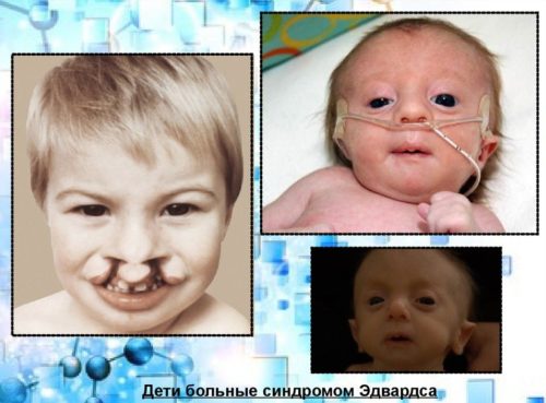 Синдром Эдвардса
