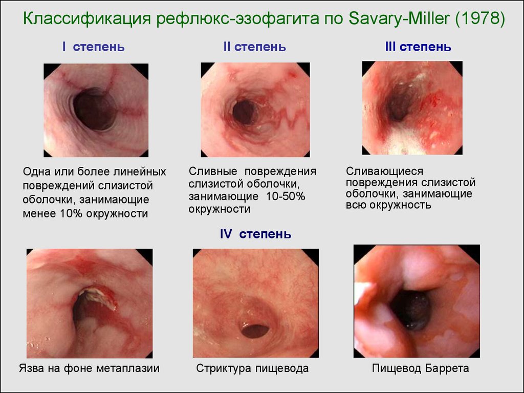 Классификация рефлюкс-эзофагита