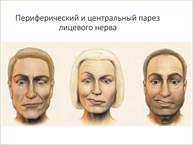 Парез лицевого нерва