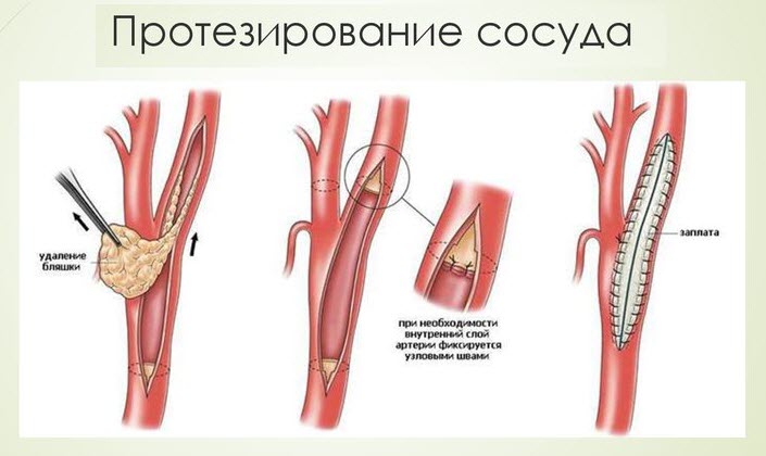 Протезирование сосуда