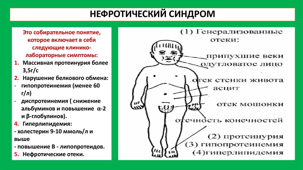 Нефротический синдром