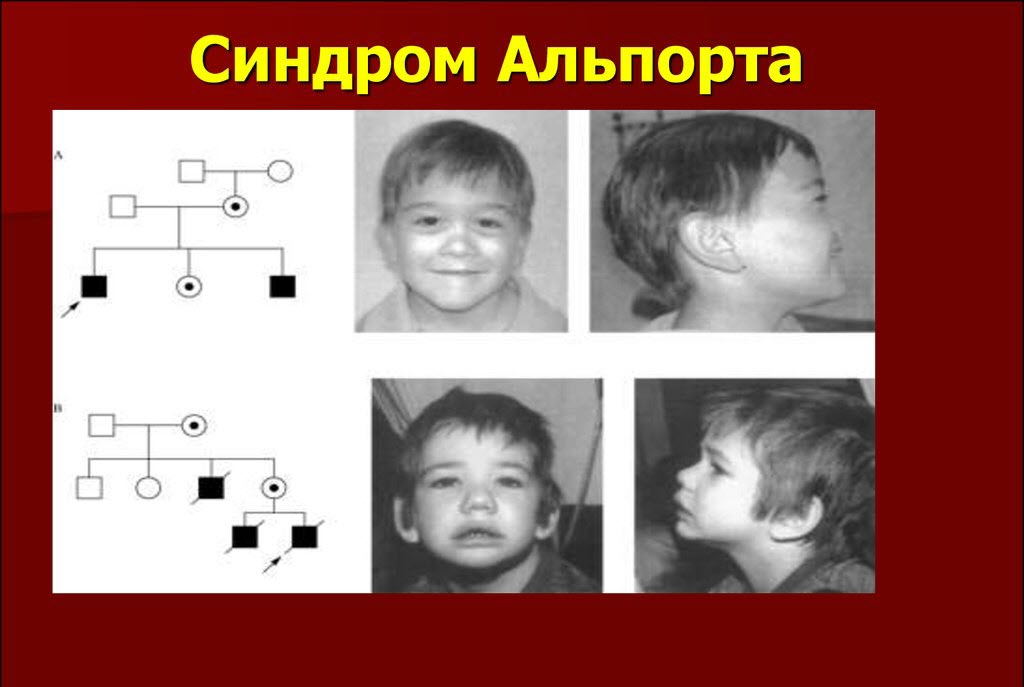 Генетическое наследование синдрома Альпорта