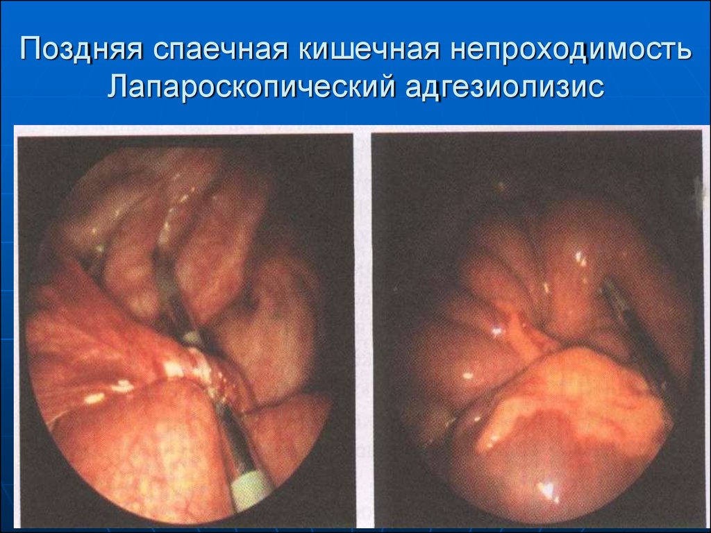 Спасечная кишечная непроходимость
