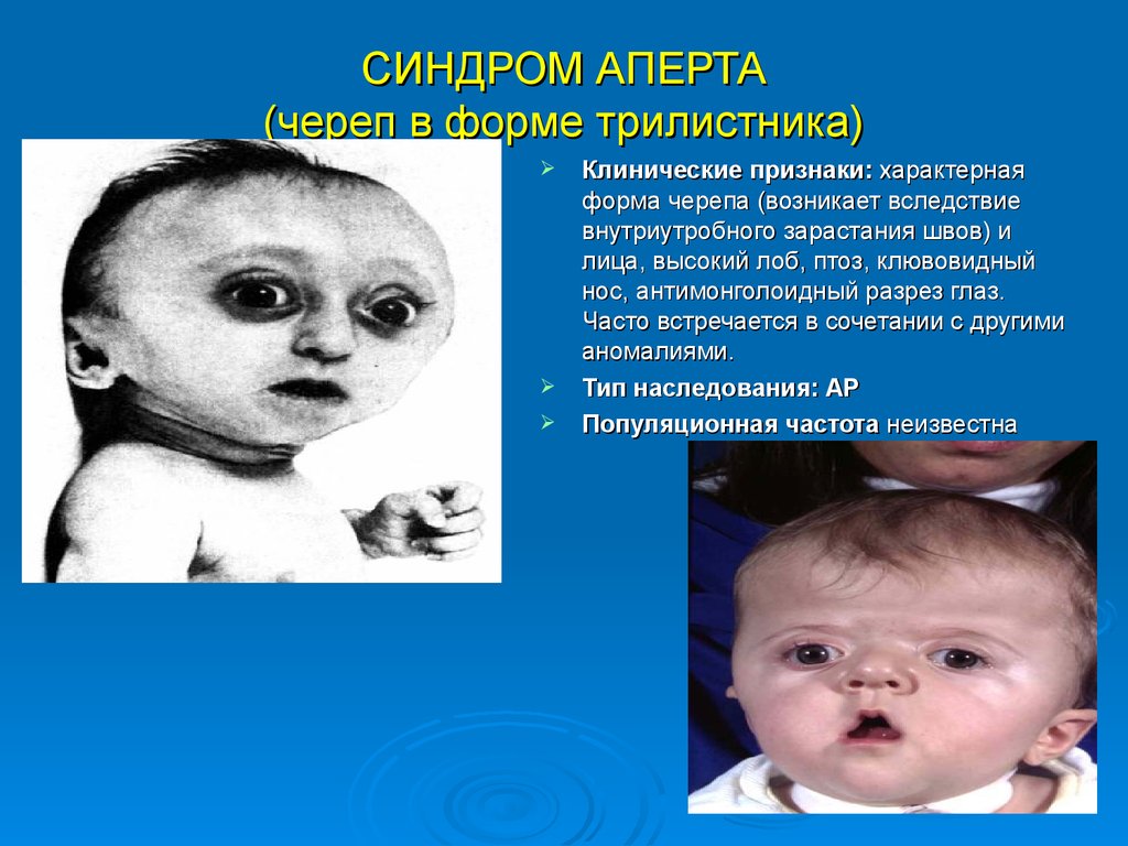 Дети с синдромом Аперта