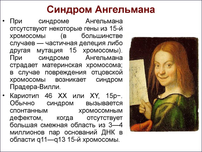 Синдром Ангельмана