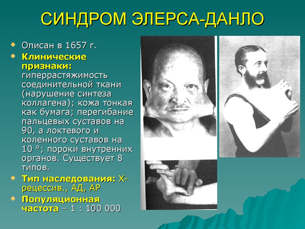 Признаки синдрома Синдром Элерса-Данлоса