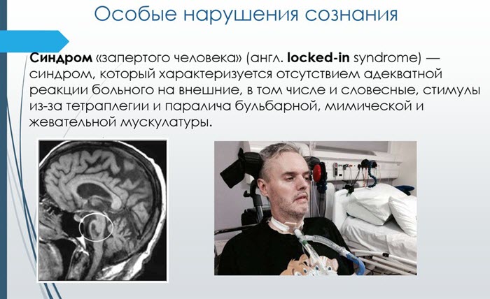 О синдроме запертого человека