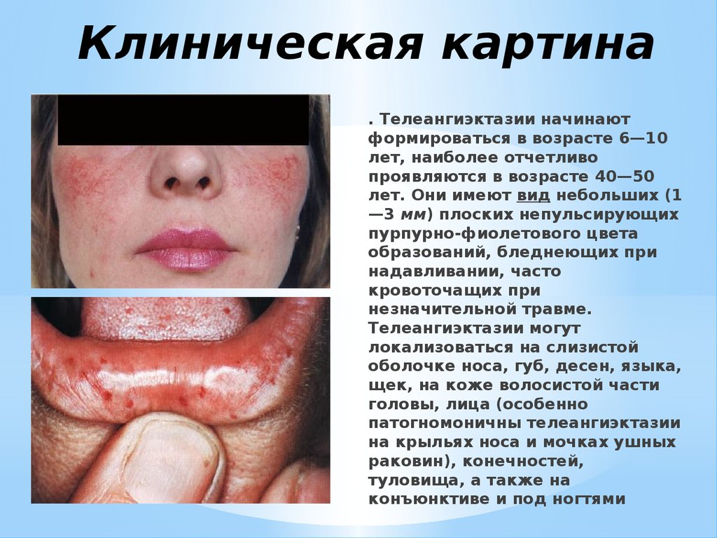 Синдром Ослера