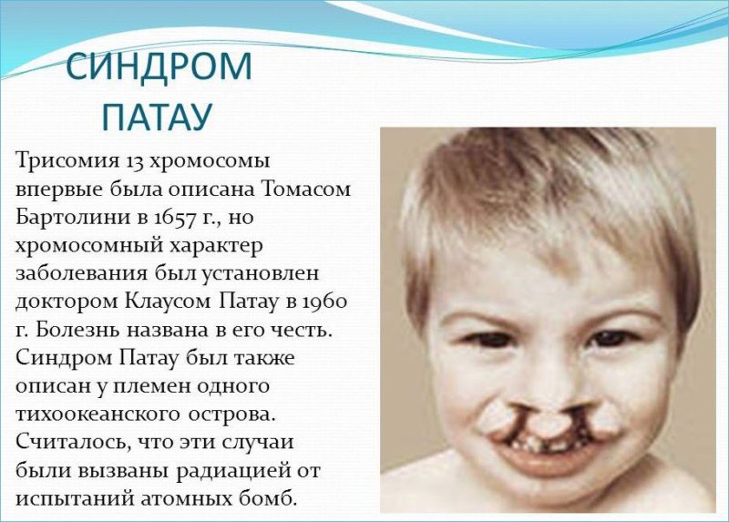 Описание синдрома Патау